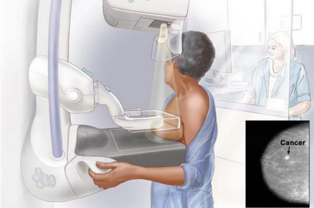 Chụp nhũ ảnh (Mammography), tầm soát ung thư vú