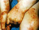 Eczema có liên quan đến một loại ung thư bạch huyết
