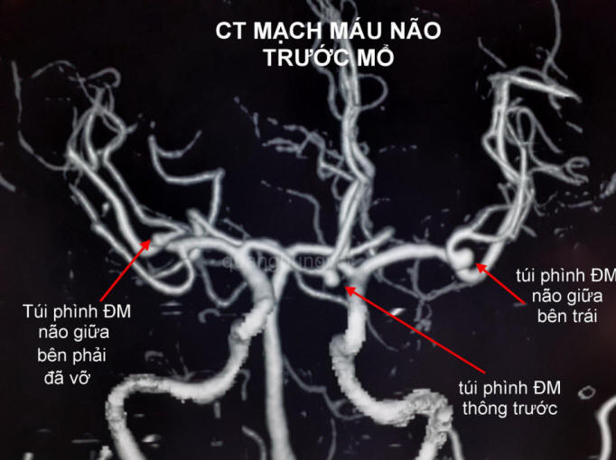 CT scan túi phình động mạch não