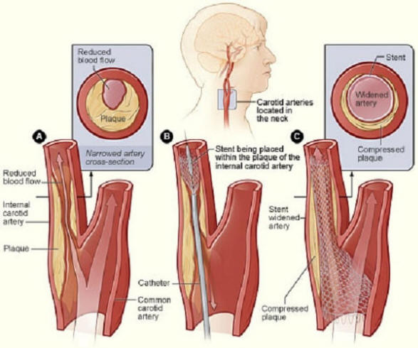 Bệnh động mạch cảnh - dấu hiệu, triệu chứng và cách điều trị